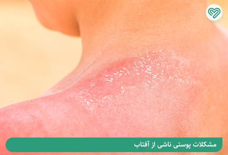 بیماری های پوستی ناشی از آفتاب