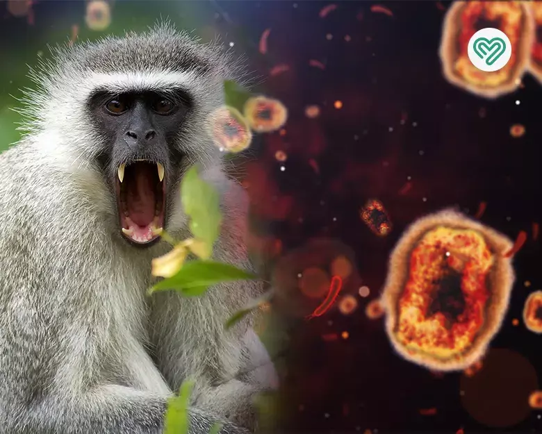 راه‌های درمان ویروس آبله میمون و جلوگیری از شیوع علائم آن