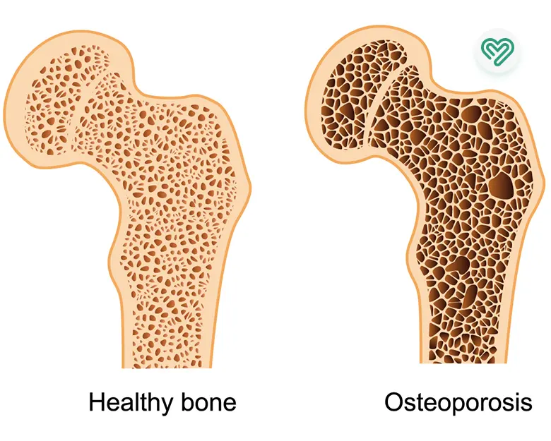 درمان پوکی استخوان با داروی مناسب و جلوگیری از بروز علائم آن