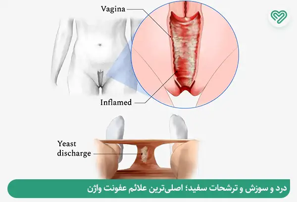 علائم عفونت واژن