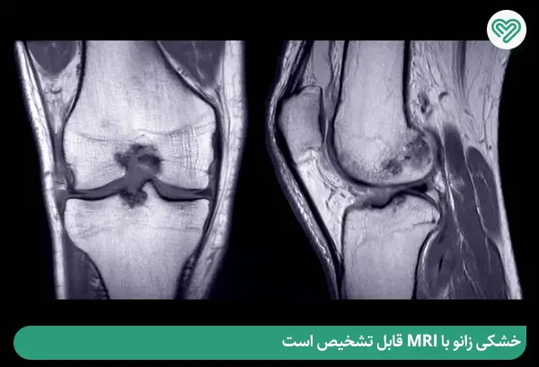 عکس MRI برای تشخیص خشکی زانو