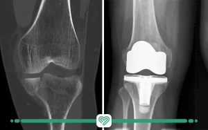 عکس رادیولوژی پلاتین بعد از شکستگی زانو